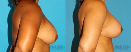 Revision Breast Surgery case #7878