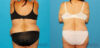Post Bariatric Surgery (Massive Weight Loss) case #6778 slider thumbnail