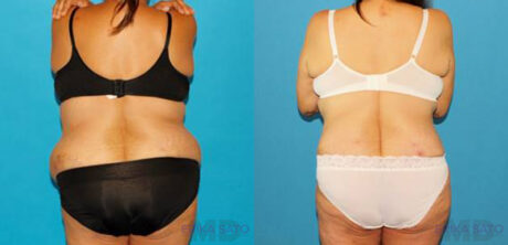 Post Bariatric Surgery (Massive Weight Loss) case #6778