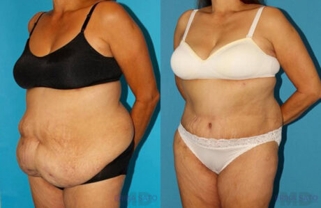 Post Bariatric Surgery (Massive Weight Loss) case #6778