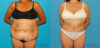 Post Bariatric Surgery (Massive Weight Loss) case #6778 slider thumbnail