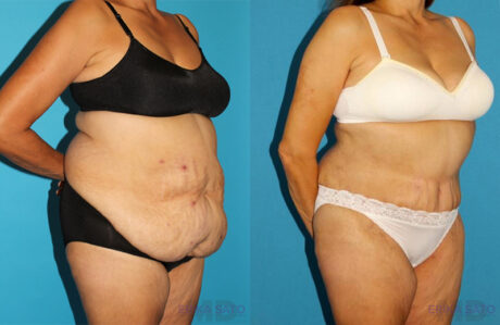 Post Bariatric Surgery (Massive Weight Loss) case #6778