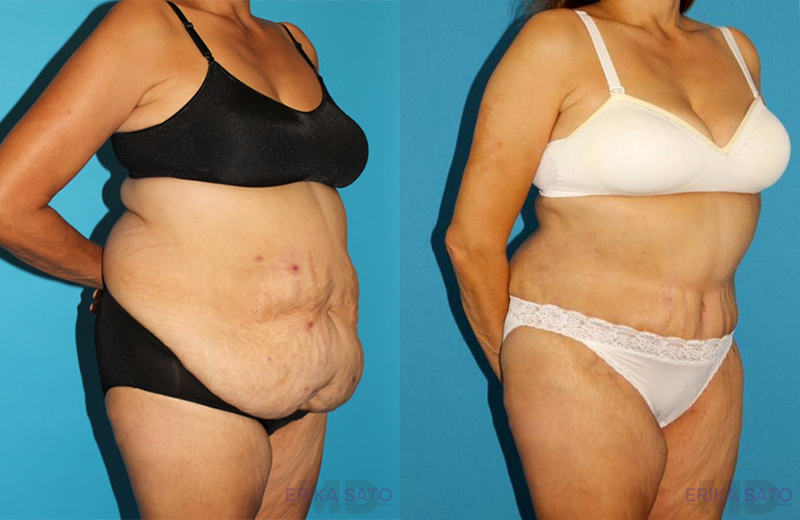 Post Bariatric Surgery (Massive Weight Loss) case #6778