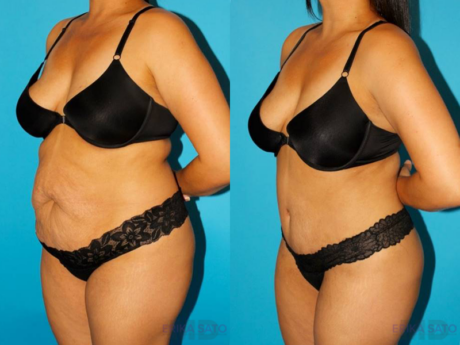 Tummy Tuck case #7276