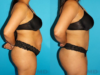 Tummy Tuck case #7276 slider thumbnail