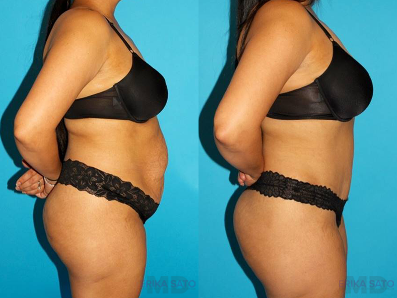 Tummy Tuck case #7276