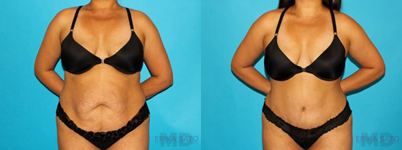 Tummy Tuck case #7276