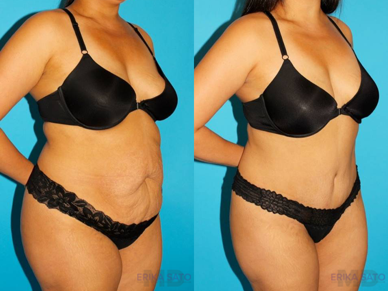 Tummy Tuck case #7276