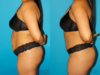 Tummy Tuck case #7276 slider thumbnail