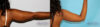 Liposuction case #5837 slider thumbnail