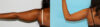 Liposuction case #5837 slider thumbnail