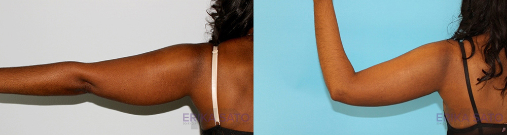 Liposuction case #5837