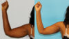 Liposuction case #5837 slider thumbnail