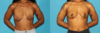 Breast Lift case #7005 slider thumbnail