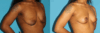 Breast Lift case #7005 slider thumbnail