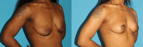Breast Lift case #7005