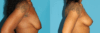 Breast Lift case #7005 slider thumbnail