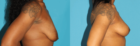 Breast Lift case #7005