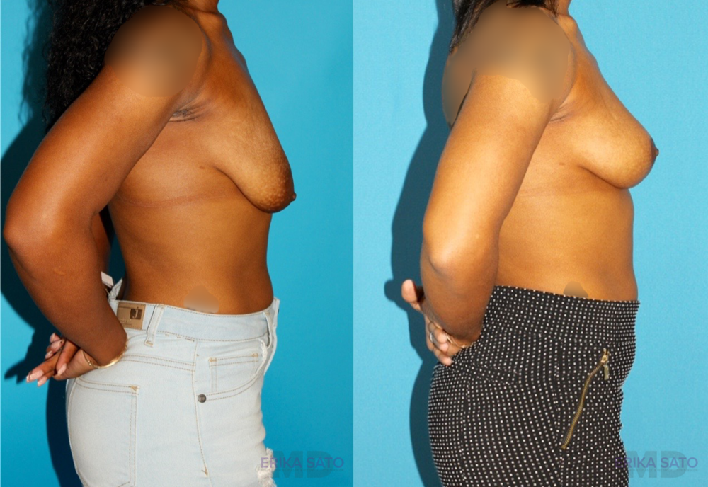 Breast Lift case #7005
