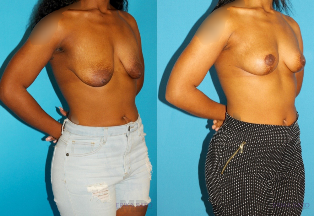 Breast Lift case #7005