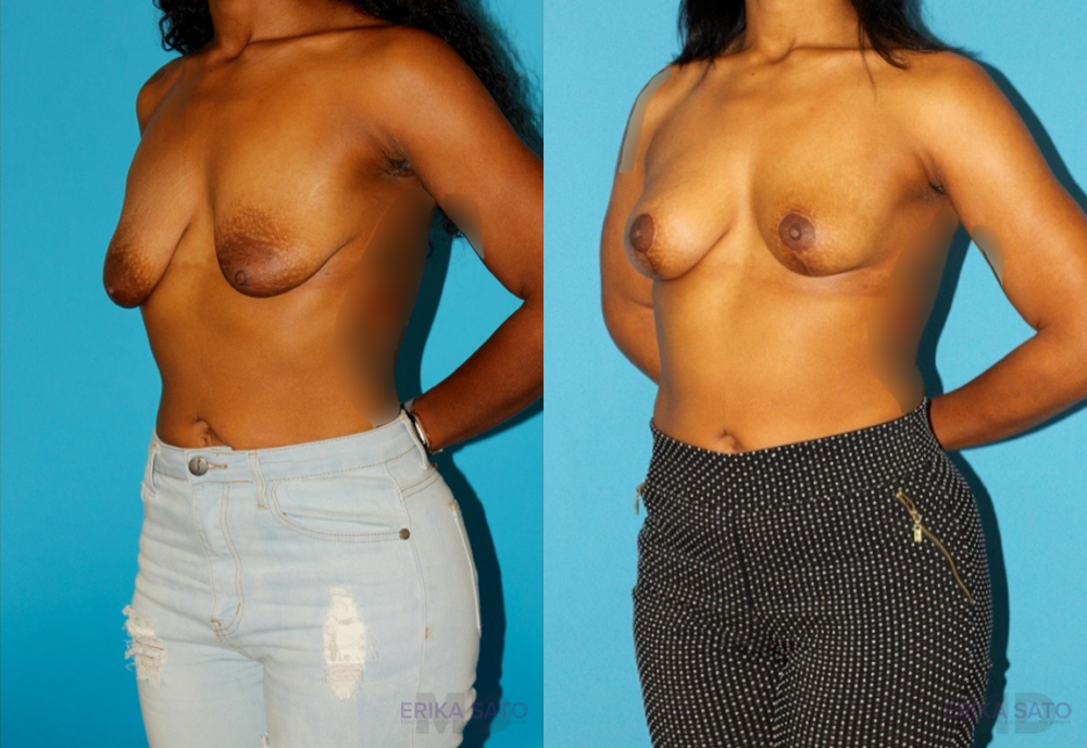 Breast Lift case #7005