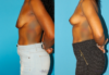 Breast Lift case #7005 slider thumbnail