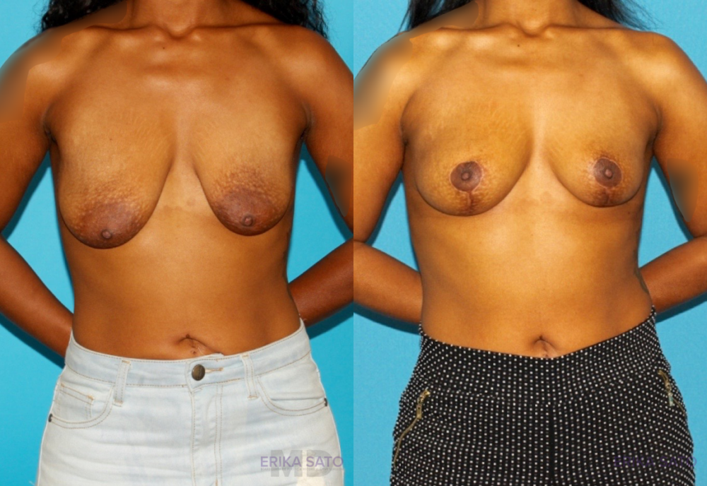 Breast Lift case #7005