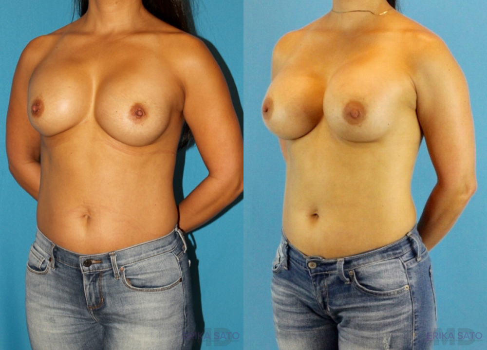 Revision Breast Surgery case #256248