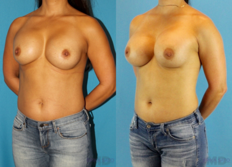 Revision Breast Surgery case #256248