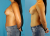 Revision Breast Surgery case #256248 slider thumbnail