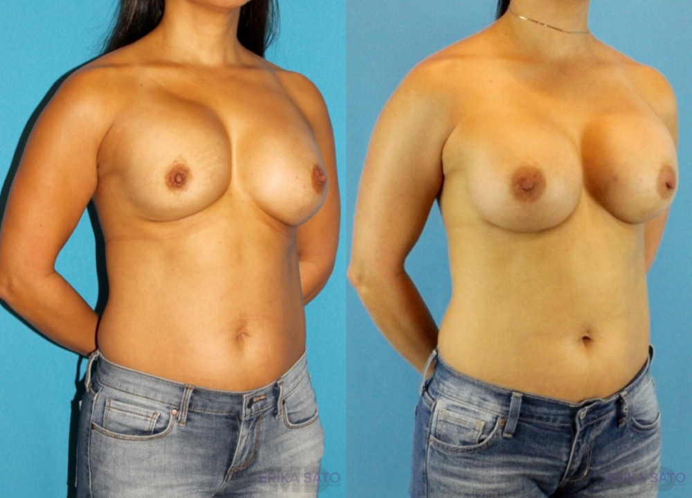 Revision Breast Surgery case #256248