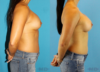 Revision Breast Surgery case #256248 slider thumbnail