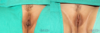 Labiaplasty case #5753 slider thumbnail