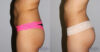 Liposuction case #5836 slider thumbnail