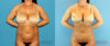 Brazilian Butt Lift case #4820 slider thumbnail