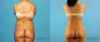Brazilian Butt Lift case #4820 slider thumbnail