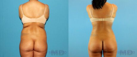 Brazilian Butt Lift case #4820