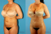 Brazilian Butt Lift case #4820 slider thumbnail