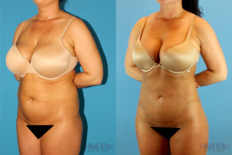 Brazilian Butt Lift case #4820