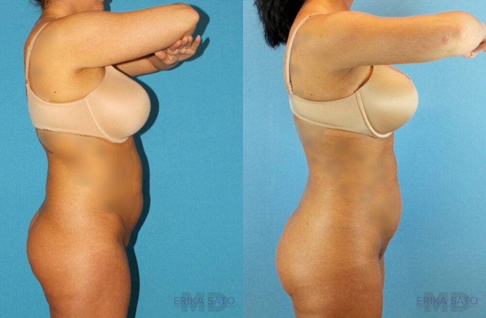 Brazilian Butt Lift case #4820