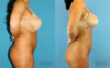 Brazilian Butt Lift case #4820 slider thumbnail