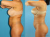 Brazilian Butt Lift case #4820 slider thumbnail