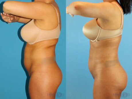 Brazilian Butt Lift case #4820