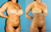 Brazilian Butt Lift case #4820 slider thumbnail