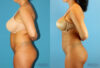 Brazilian Butt Lift case #4820 slider thumbnail