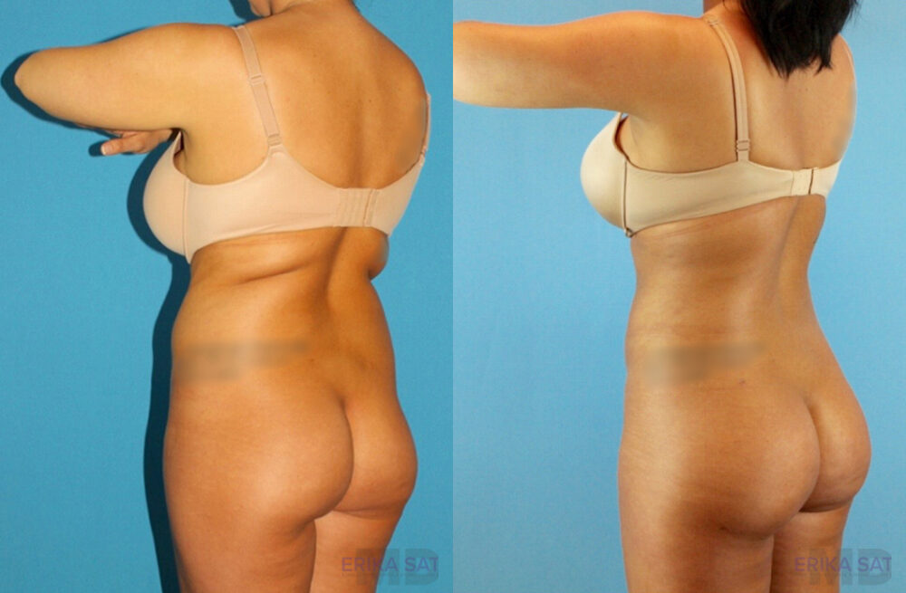 Brazilian Butt Lift case #4820
