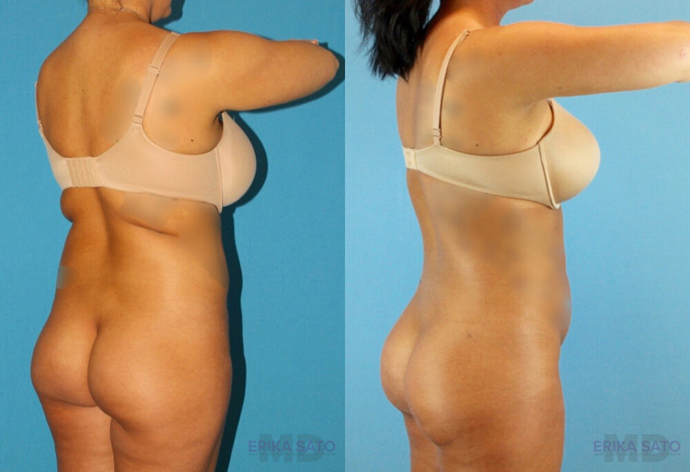 Brazilian Butt Lift case #4820