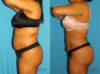 Brazilian Butt Lift case #4676 slider thumbnail