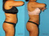 Brazilian Butt Lift case #4676 slider thumbnail