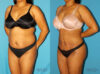 Brazilian Butt Lift case #4676 slider thumbnail